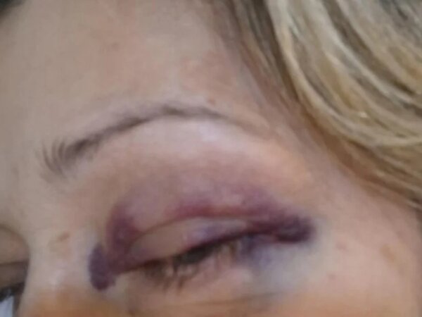 «Θα το ξαναέκανα και με μωβ μάτι» – Συγκινεί η δασκάλα που προστάτευσε τους μαθητές της από επίθεση σε σχολικό πρωτάθλημα